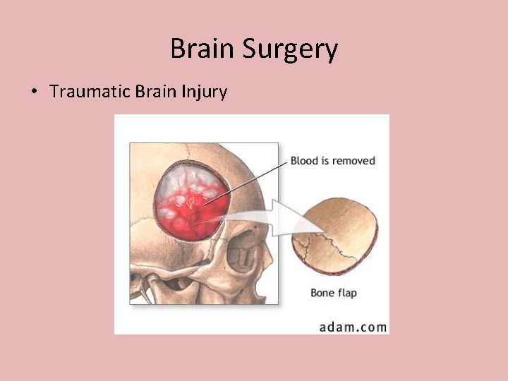 Brain Surgery • Traumatic Brain Injury 