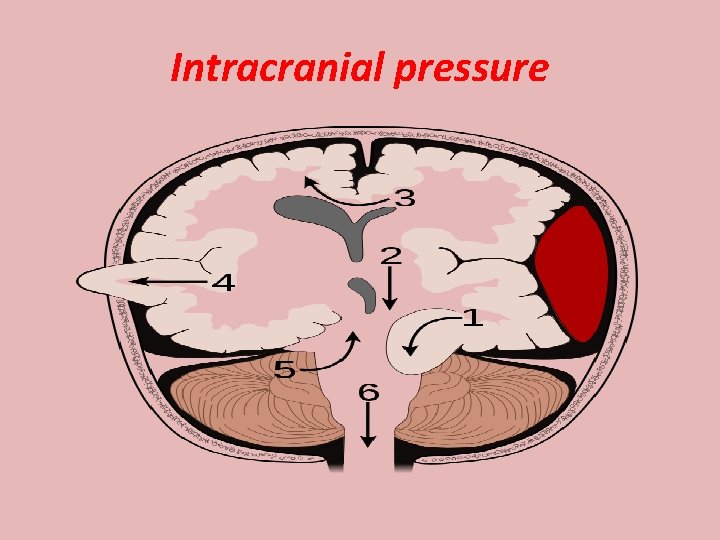 Intracranial pressure 