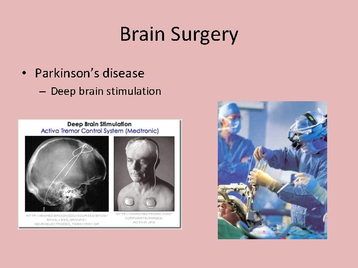 Brain Surgery • Parkinson’s disease – Deep brain stimulation 