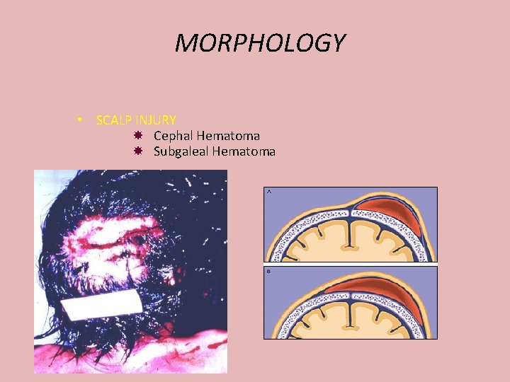 MORPHOLOGY • SCALP INJURY Cephal Hematoma Subgaleal Hematoma 