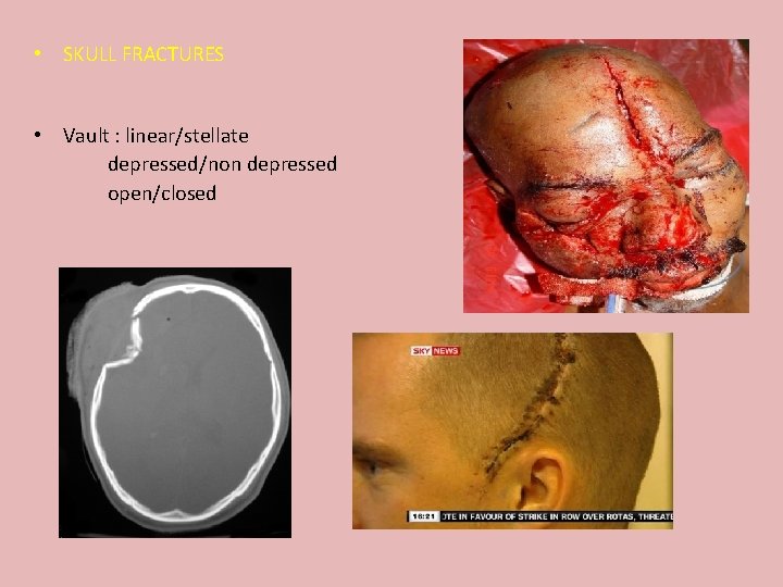  • SKULL FRACTURES • Vault : linear/stellate depressed/non depressed open/closed 