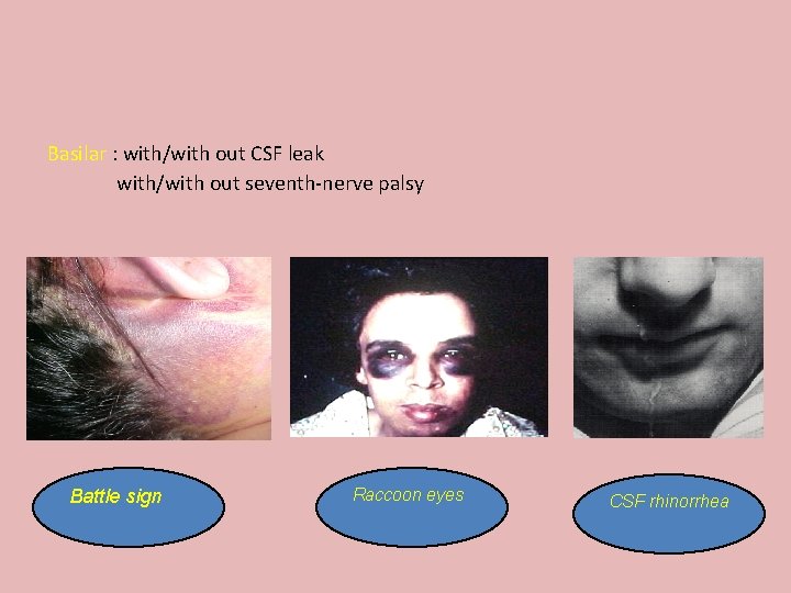 Basilar : with/with out CSF leak with/with out seventh-nerve palsy Battle sign Raccoon eyes