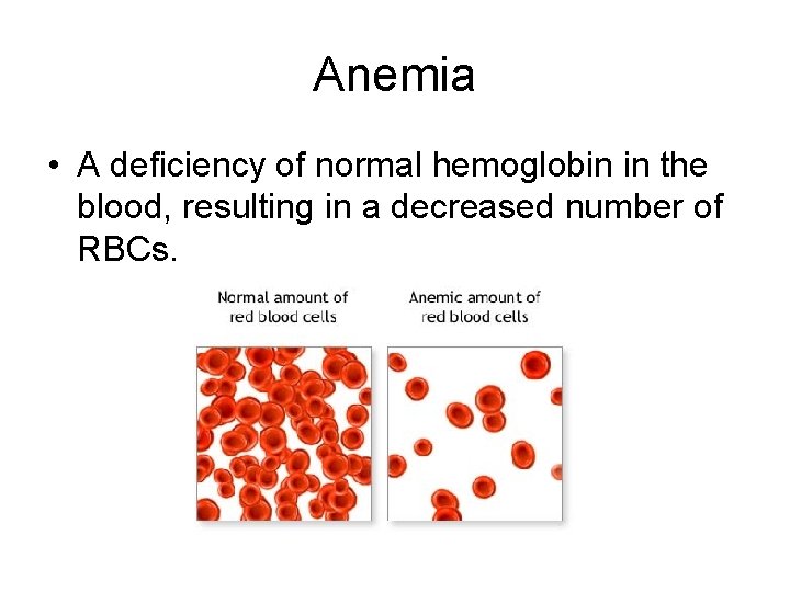 Anemia • A deficiency of normal hemoglobin in the blood, resulting in a decreased
