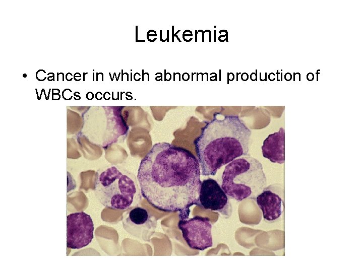 Leukemia • Cancer in which abnormal production of WBCs occurs. 