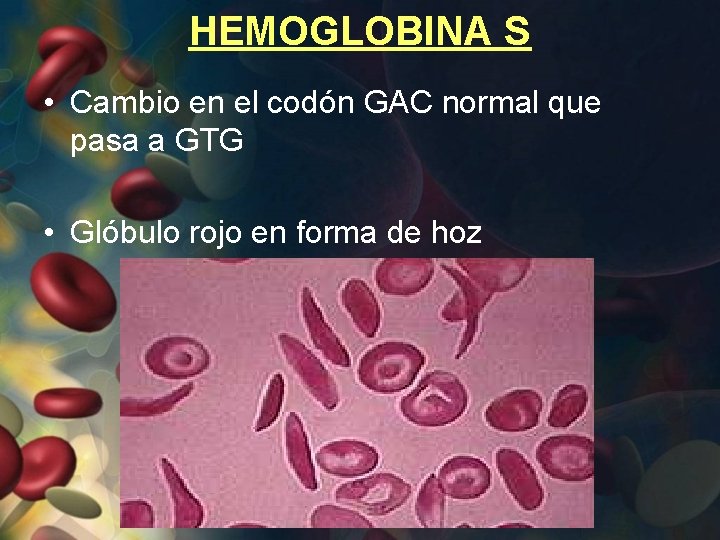 HEMOGLOBINA S • Cambio en el codón GAC normal que pasa a GTG •