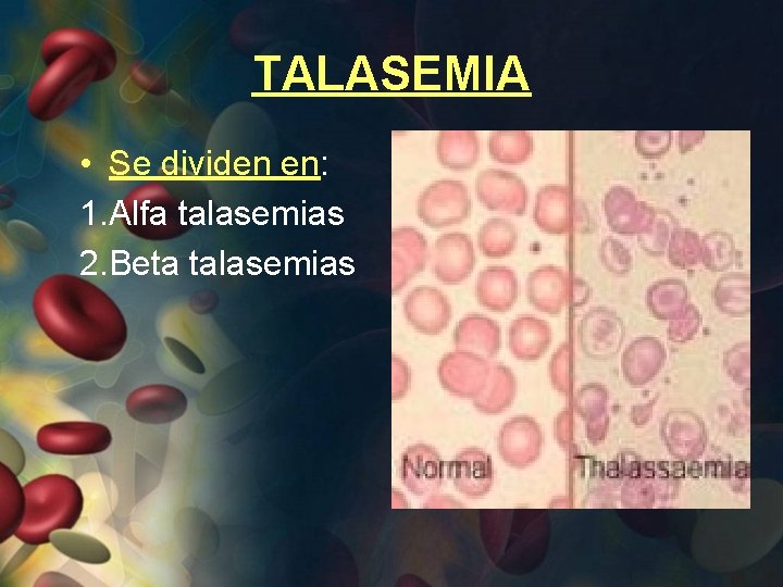 TALASEMIA • Se dividen en: 1. Alfa talasemias 2. Beta talasemias 