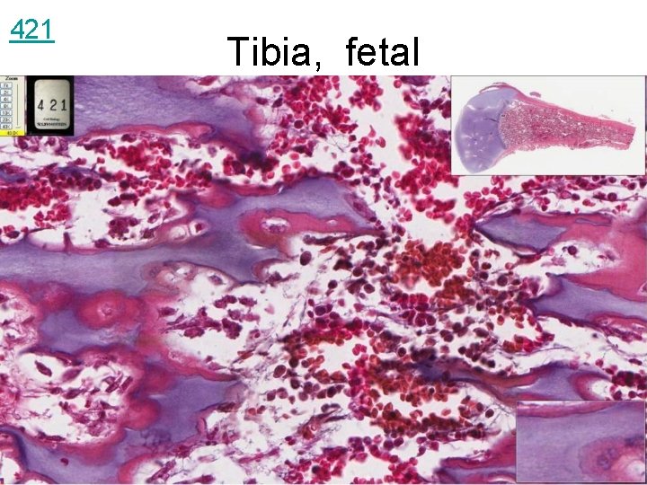 421 Tibia, fetal 