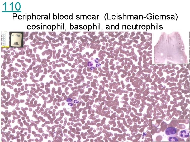 110 Peripheral blood smear (Leishman-Giemsa) eosinophil, basophil, and neutrophils 