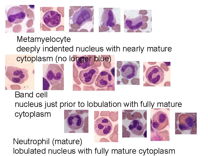 Metamyelocyte deeply indented nucleus with nearly mature cytoplasm (no longer blue) Band cell nucleus