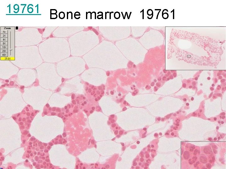 19761 Bone marrow 19761 