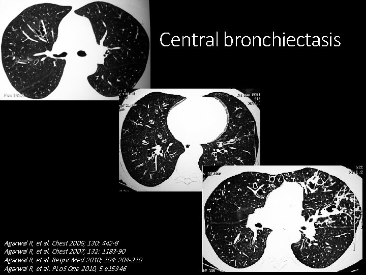 Central bronchiectasis Agarwal R, et al. Chest 2006; 130: 442 -8 Agarwal R, et