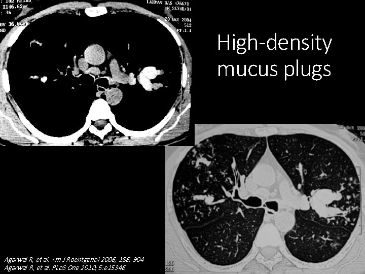 High-density mucus plugs Agarwal R, et al. Am J Roentgenol 2006; 186: 904 Agarwal