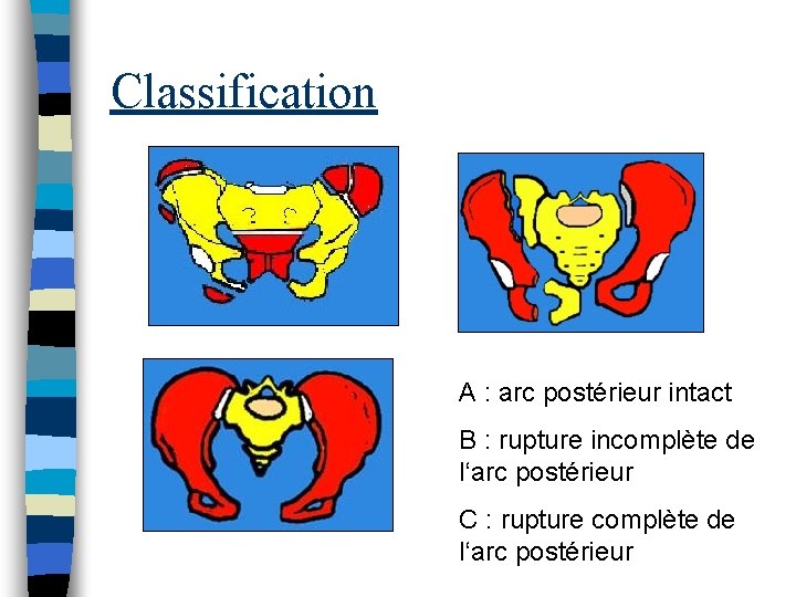 Classification A : arc postérieur intact B : rupture incomplète de l‘arc postérieur C