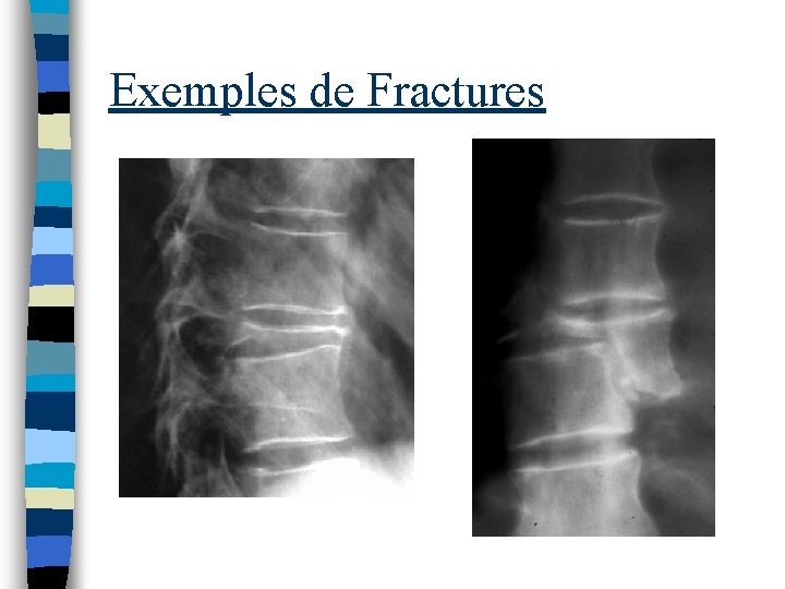 Exemples de Fractures 