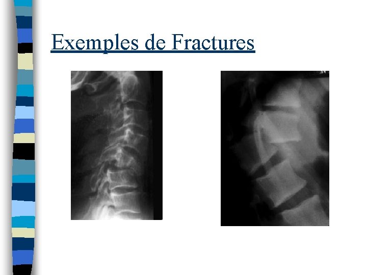 Exemples de Fractures 
