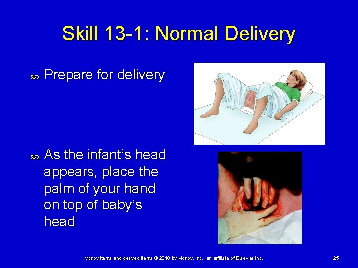 Skill 13 -1: Normal Delivery Prepare for delivery As the infant’s head appears, place Skill 13 -1: Normal Delivery Prepare for delivery As the infant’s head appears, place