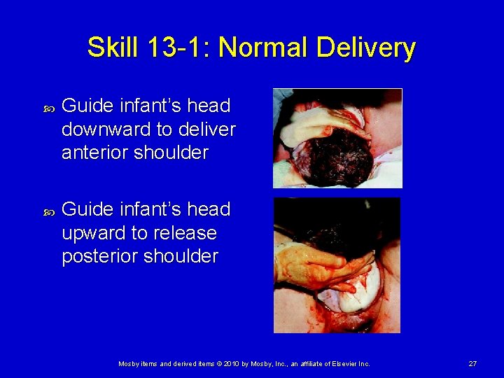 Skill 13 -1: Normal Delivery Guide infant’s head downward to deliver anterior shoulder Guide Skill 13 -1: Normal Delivery Guide infant’s head downward to deliver anterior shoulder Guide