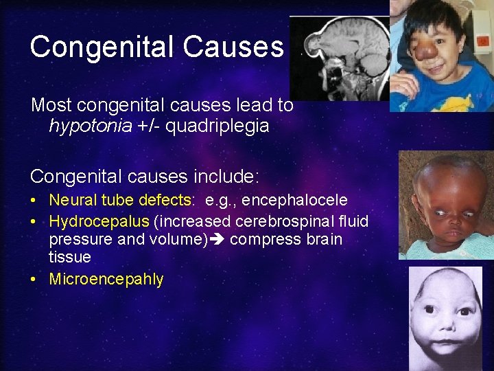 Congenital Causes Most congenital causes lead to hypotonia +/- quadriplegia Congenital causes include: •