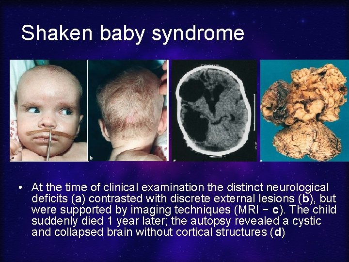 Shaken baby syndrome • At the time of clinical examination the distinct neurological deficits