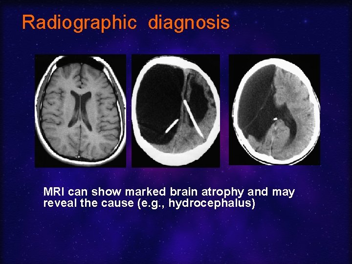 Radiographic diagnosis MRI can show marked brain atrophy and may reveal the cause (e.