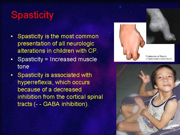 Spasticity • Spasticity is the most common presentation of all neurologic alterations in children