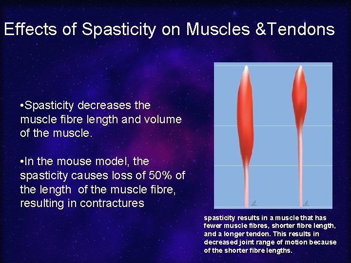 Effects of Spasticity on Muscles &Tendons • Spasticity decreases the muscle fibre length and