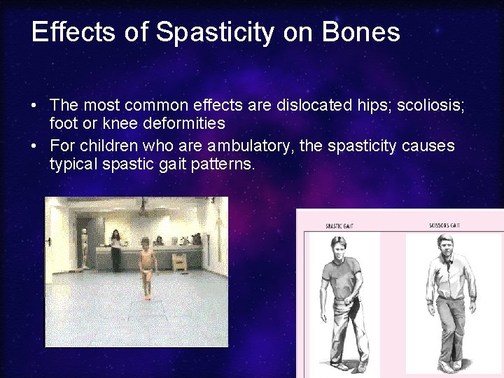 Effects of Spasticity on Bones • The most common effects are dislocated hips; scoliosis;