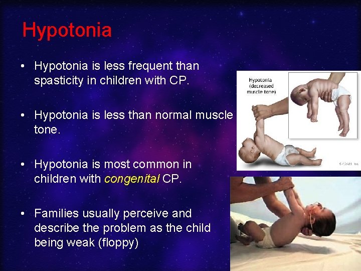 Hypotonia • Hypotonia is less frequent than spasticity in children with CP. • Hypotonia