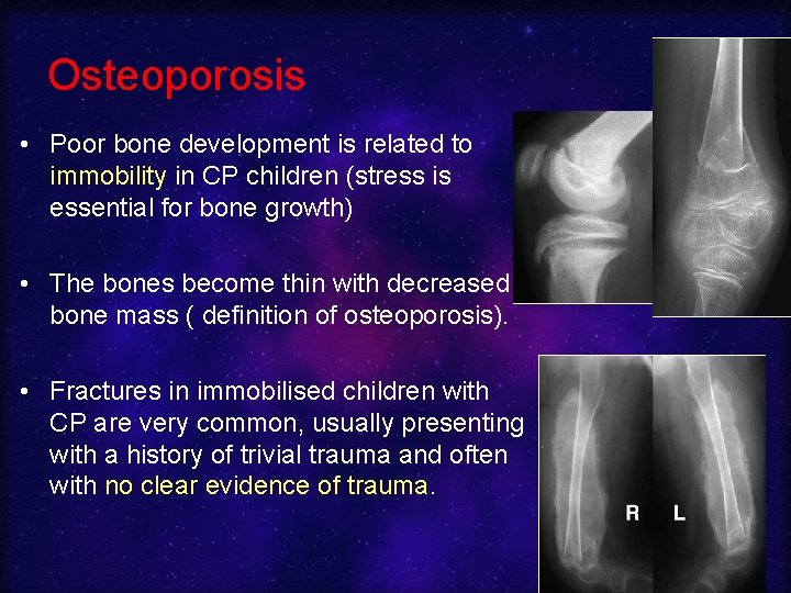 Osteoporosis • Poor bone development is related to immobility in CP children (stress is