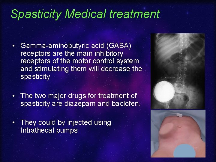 Spasticity Medical treatment • Gamma-aminobutyric acid (GABA) receptors are the main inhibitory receptors of