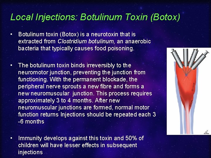 Local Injections: Botulinum Toxin (Botox) • Botulinum toxin (Botox) is a neurotoxin that is