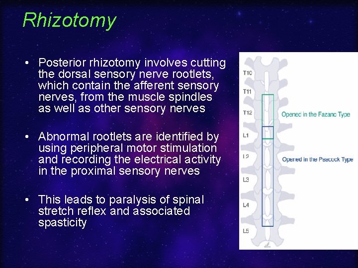Rhizotomy • Posterior rhizotomy involves cutting the dorsal sensory nerve rootlets, which contain the