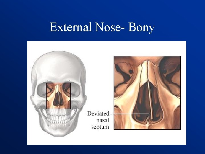 External Nose- Bony 
