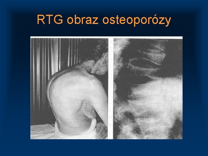 RTG obraz osteoporózy 