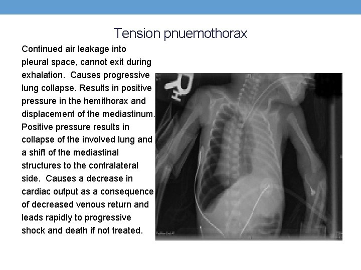 Tension pnuemothorax Continued air leakage into pleural space, cannot exit during exhalation. Causes progressive