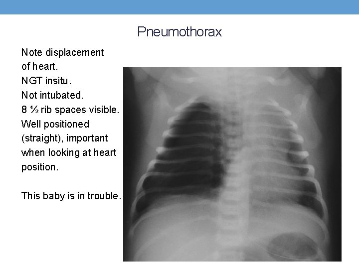 Pneumothorax Note displacement of heart. NGT insitu. Not intubated. 8 ½ rib spaces visible.
