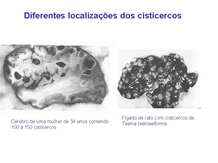 Diferentes localizações dos cisticercos Cérebro de uma mulher de 34 anos contendo 100 a