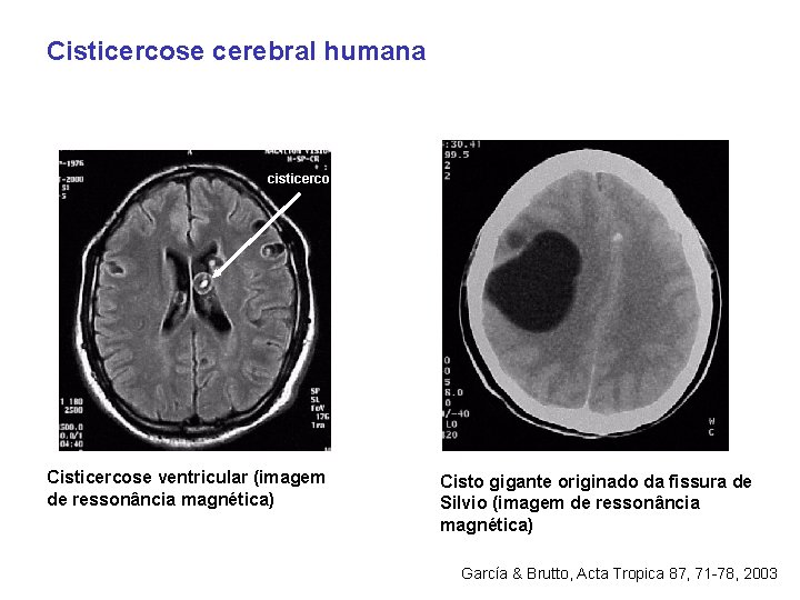 Cisticercose cerebral humana cisticerco Cisticercose ventricular (imagem de ressonância magnética) Cisto gigante originado da