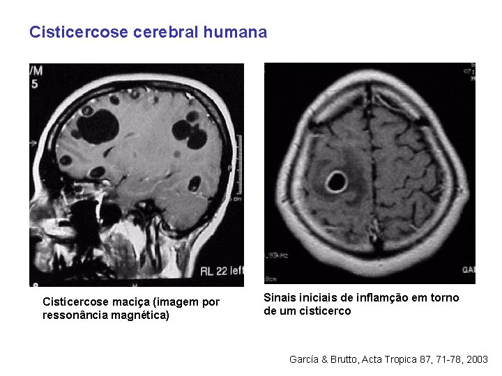 Cisticercose cerebral humana Cisticercose maciça (imagem por ressonância magnética) Sinais iniciais de inflamção em