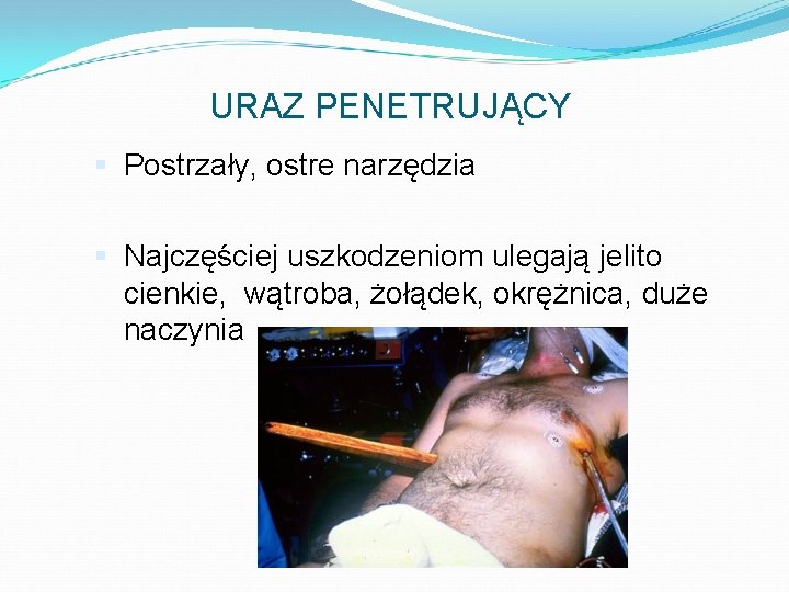 URAZ PENETRUJĄCY Postrzały, ostre narzędzia Najczęściej uszkodzeniom ulegają jelito cienkie, wątroba, żołądek, okrężnica, duże