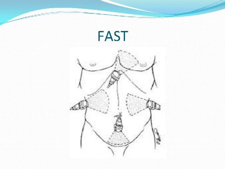 FAST 