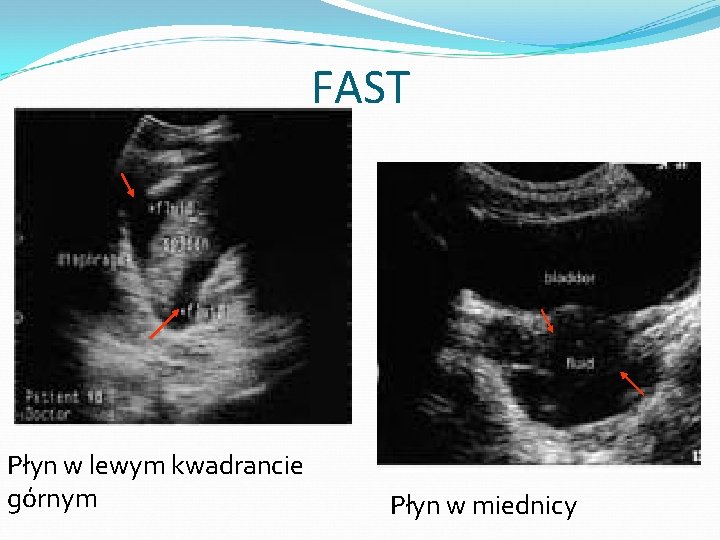 FAST Płyn w lewym kwadrancie górnym Płyn w miednicy 