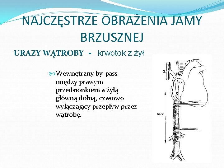 NAJCZĘSTRZE OBRAŻENIA JAMY BRZUSZNEJ URAZY WĄTROBY - krwotok z żył Wewnętrzny by-pass między prawym