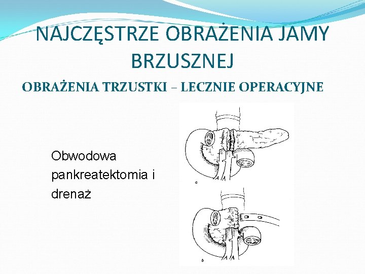 NAJCZĘSTRZE OBRAŻENIA JAMY BRZUSZNEJ OBRAŻENIA TRZUSTKI – LECZNIE OPERACYJNE Obwodowa pankreatektomia i drenaż 