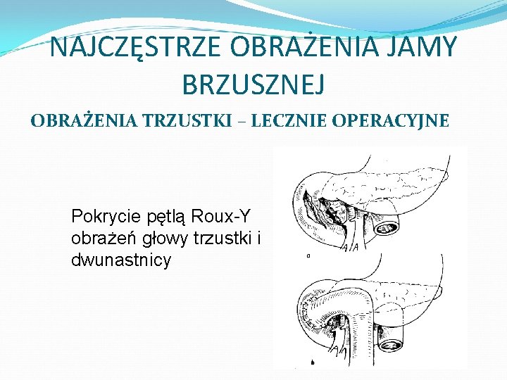 NAJCZĘSTRZE OBRAŻENIA JAMY BRZUSZNEJ OBRAŻENIA TRZUSTKI – LECZNIE OPERACYJNE Pokrycie pętlą Roux-Y obrażeń głowy