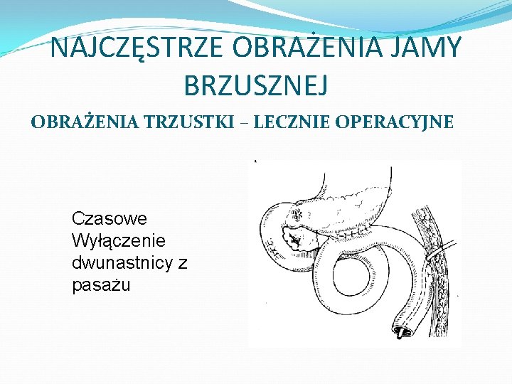 NAJCZĘSTRZE OBRAŻENIA JAMY BRZUSZNEJ OBRAŻENIA TRZUSTKI – LECZNIE OPERACYJNE Czasowe Wyłączenie dwunastnicy z pasażu