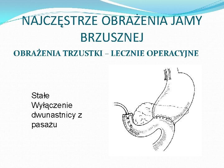 NAJCZĘSTRZE OBRAŻENIA JAMY BRZUSZNEJ OBRAŻENIA TRZUSTKI – LECZNIE OPERACYJNE Stałe Wyłączenie dwunastnicy z pasażu