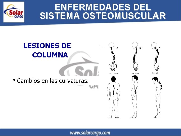 ENFERMEDADES DEL SISTEMA OSTEOMUSCULAR LESIONES DE COLUMNA i. Cambios en las curvaturas. 