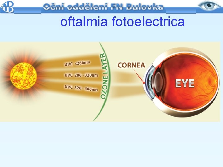 oftalmia fotoelectrica 