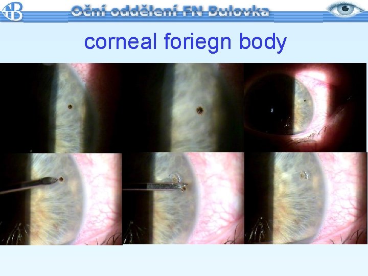corneal foriegn body 